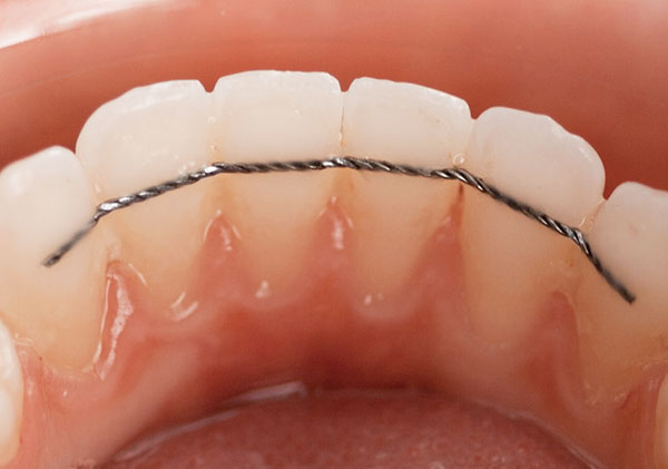 contention-orthodontie